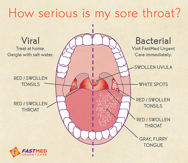 Sore Throat: Viral vs. Bacterial