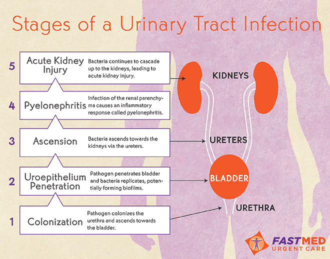 Stages of a Urinary Tract Infection [INFOGRAPHIC]