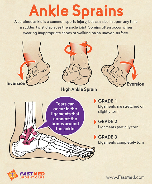 How do you care for a sprained foot?