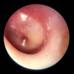 When the eardrum is swollen it is an ear infection symptom