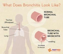 Bronchitis treatment in AZ NC