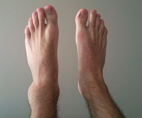 person with sprained left ankle