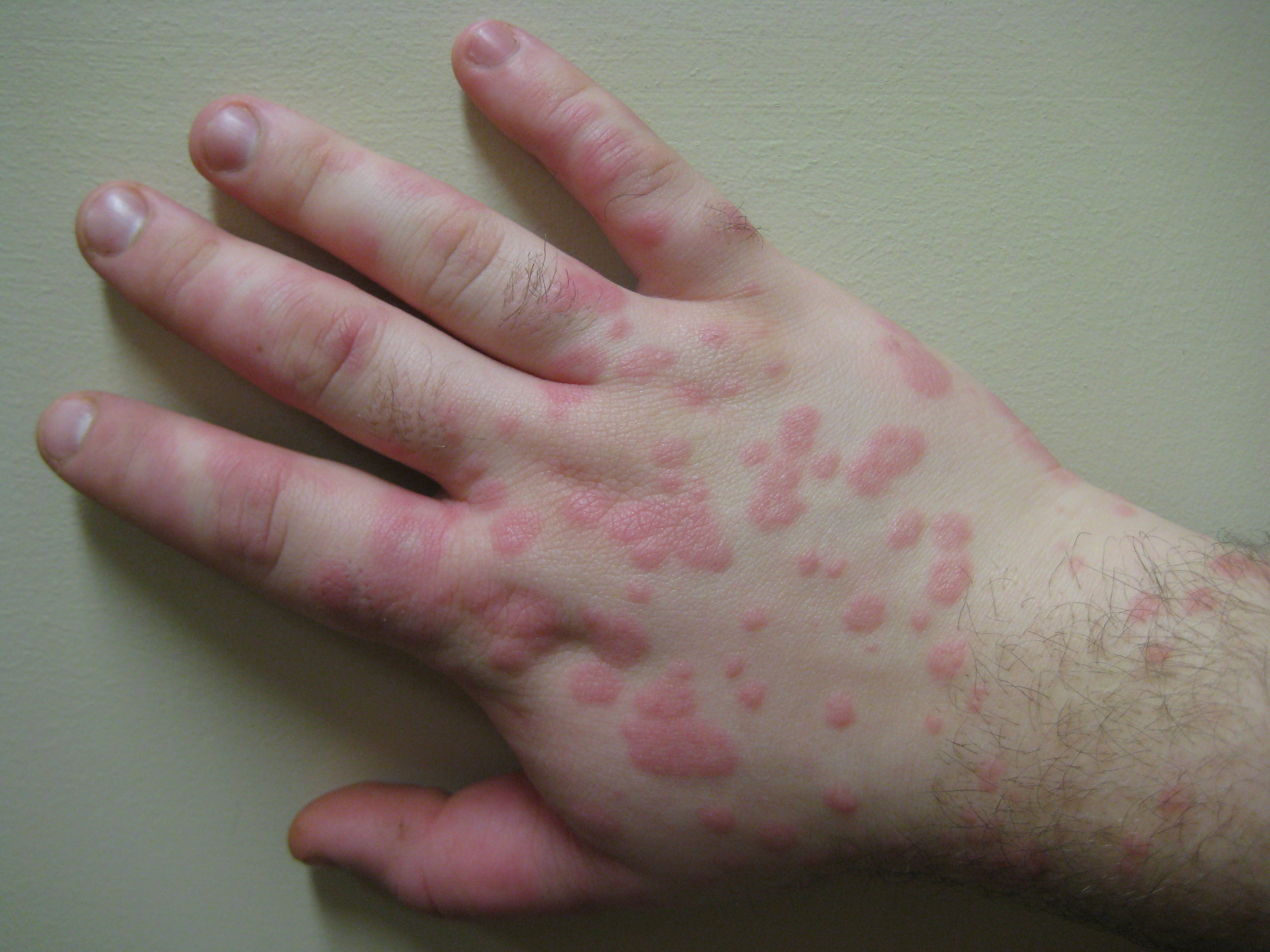 person with shingles rash on their hand 