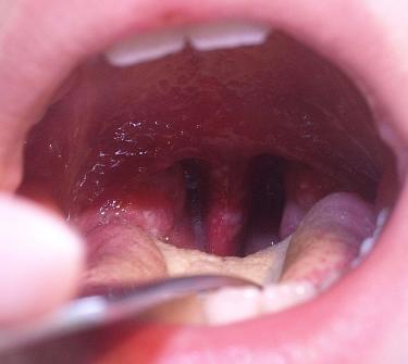 Sore Throat with Blisters -