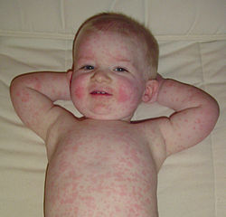 Fifth Disease