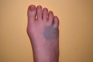 broken big toe