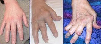 Swollen Joints in Fingers