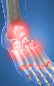 Heel Pain When Walking