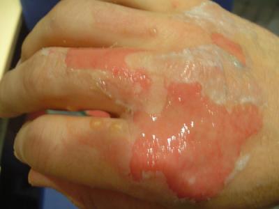 Second Degree Burns That Require Treatment
