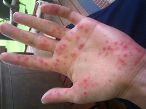 Hand Foot Mouth Disease