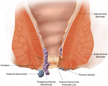 Hemorrhoid