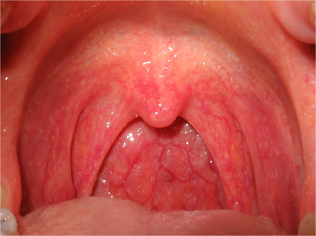 Complications of Strep Throat