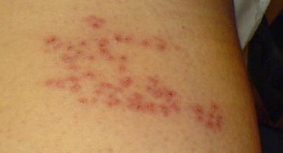 Shingles Treatment