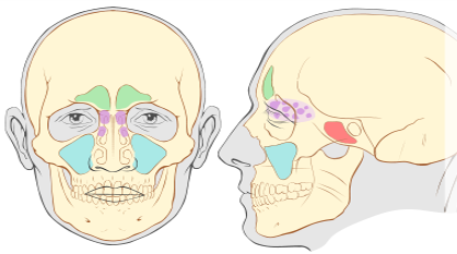 Síntomas de Sinusitis