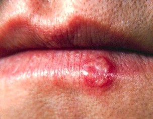 Herpes Cold Sore