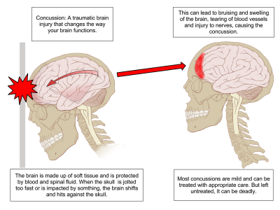 Mild Concussion