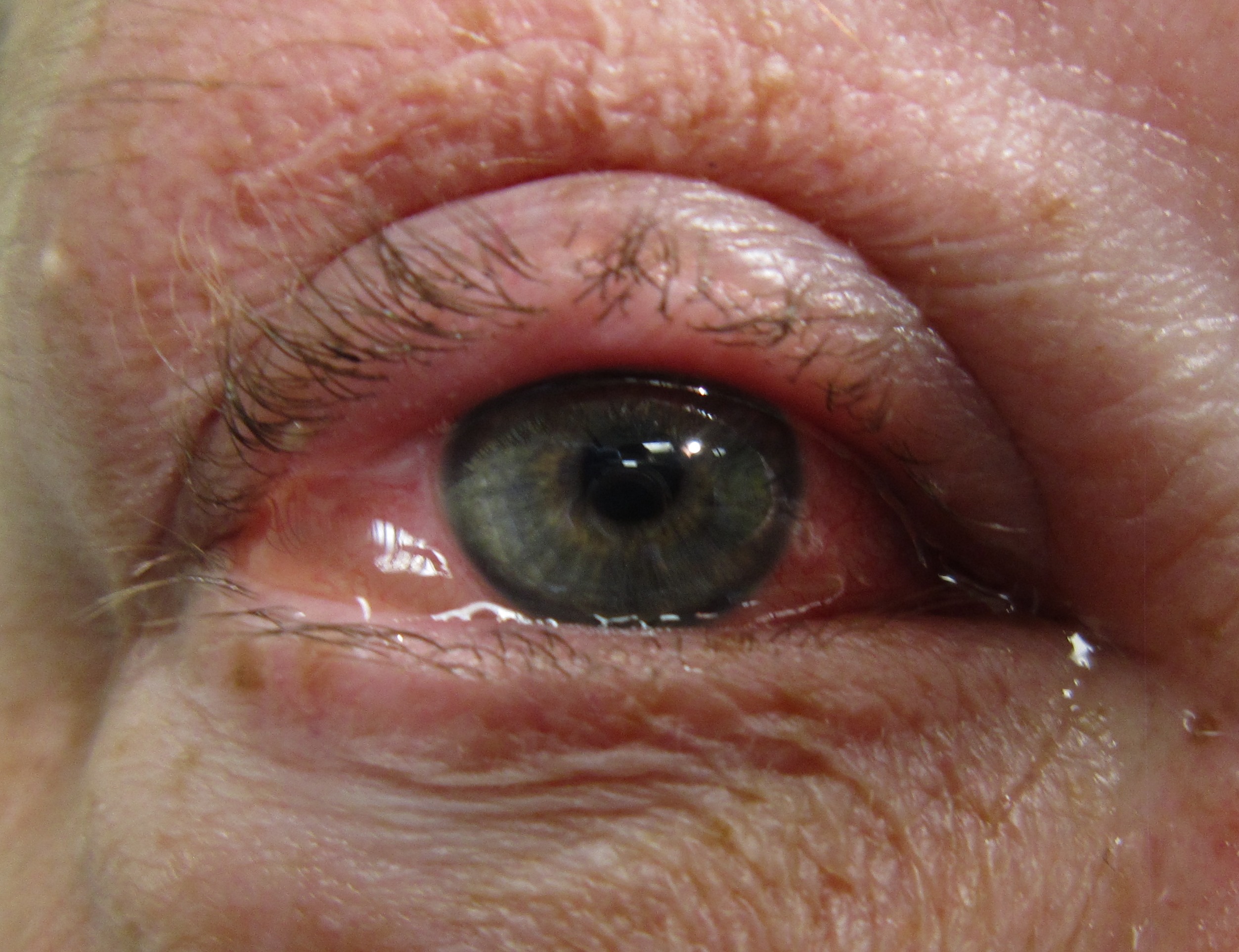 an eye with allergic conjuvitis