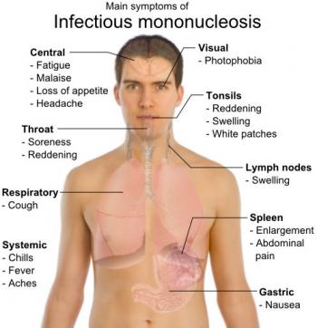 Mononucleosis