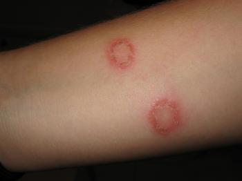 Signs and Symptoms of Ringworm