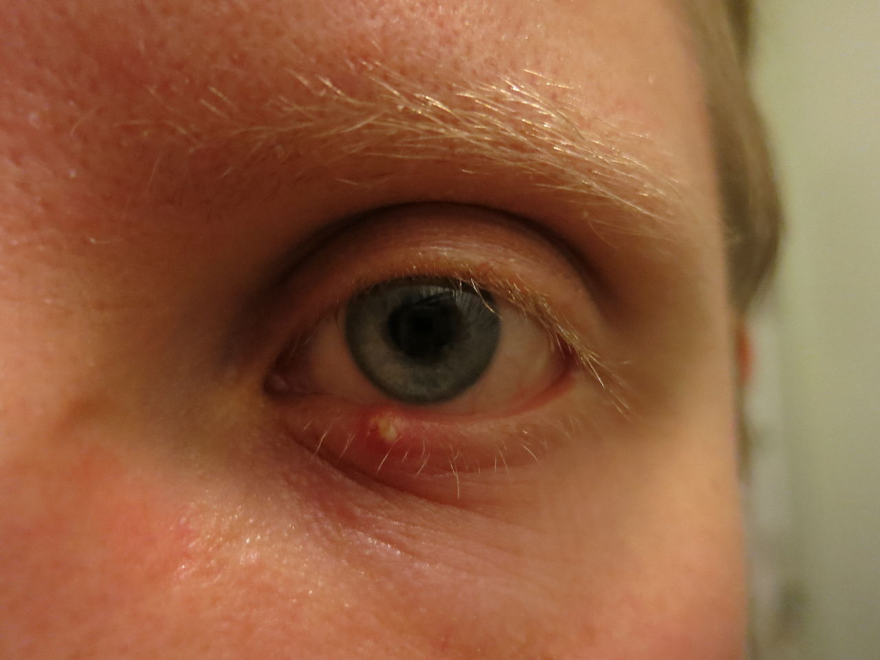 person with a stye under their eye