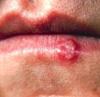 Cold Sore Remedies