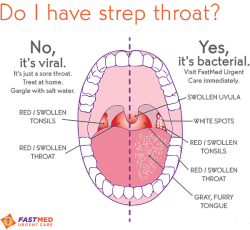 Do I Have Strep Throat