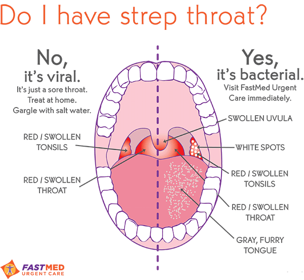 Strep Throat What It Looks Like Bumps And White Spots In Throat