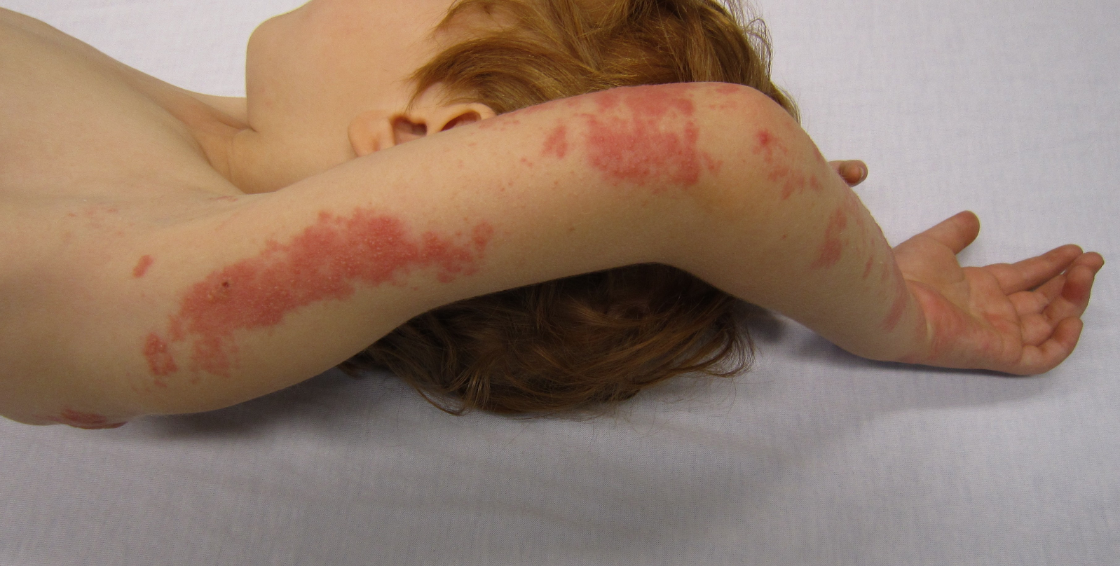 child with viral rash