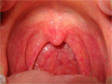 Throat pain when swallowing