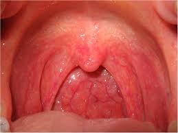 Throat Cancer