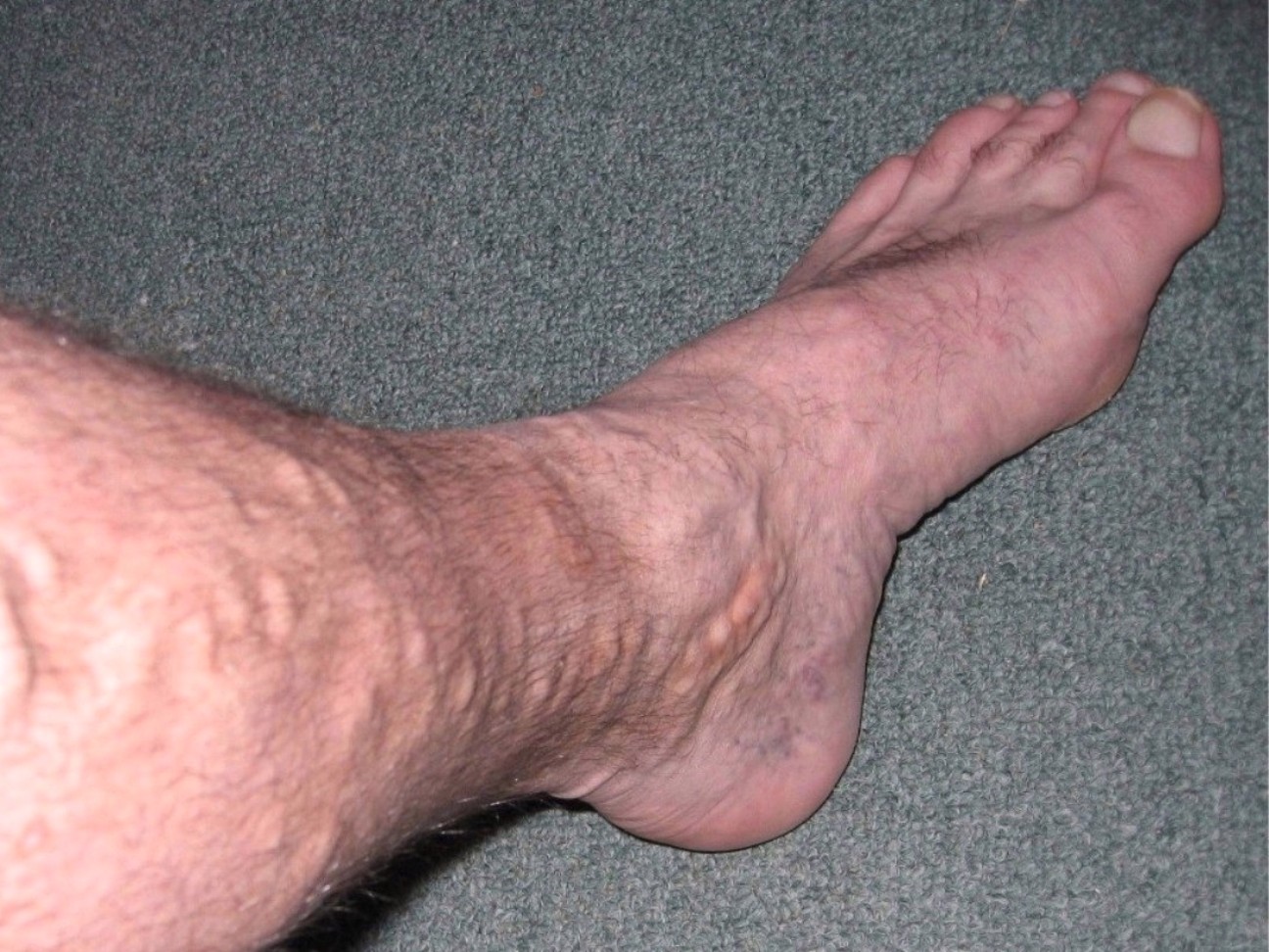 person with vericose veins in their leg