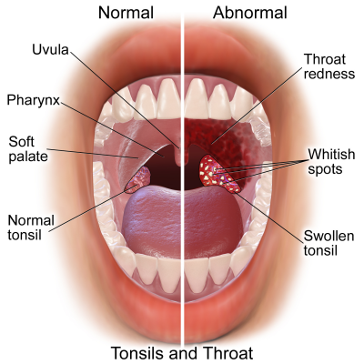 sore throat