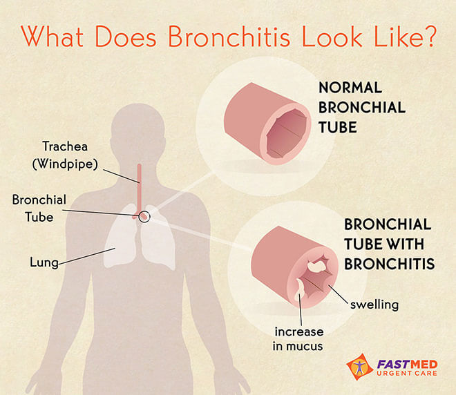 What does bronchitis look like