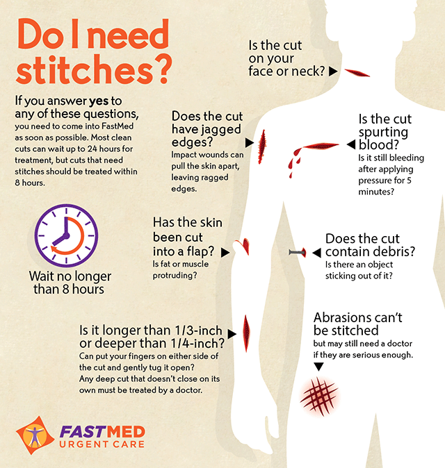 Stitching Wounds-When There is No Hospital Do-i-need-stitches-infographic