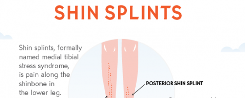 Infographic explaining shin splints